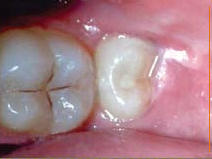 What causes a wisdom tooth infection?